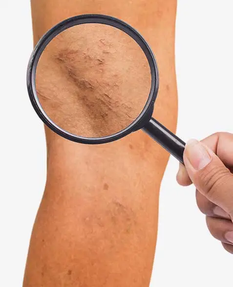 Sclerotherapy Of Spider Veins