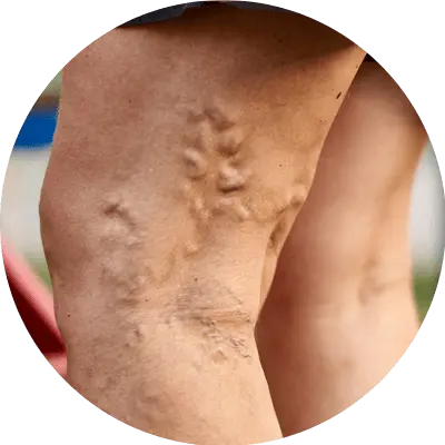 Varicose Veins