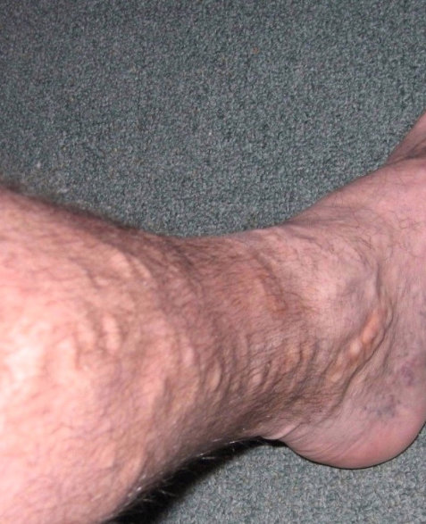 Sclerotherapy Of Varicose Veins