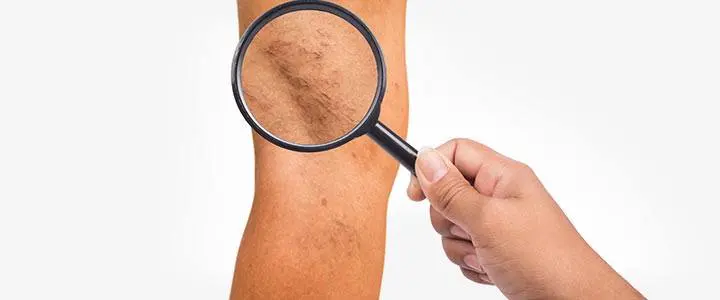 Elite Veins Sclerotherapy